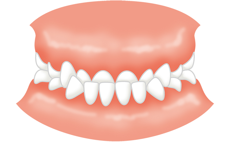乳歯の受け口